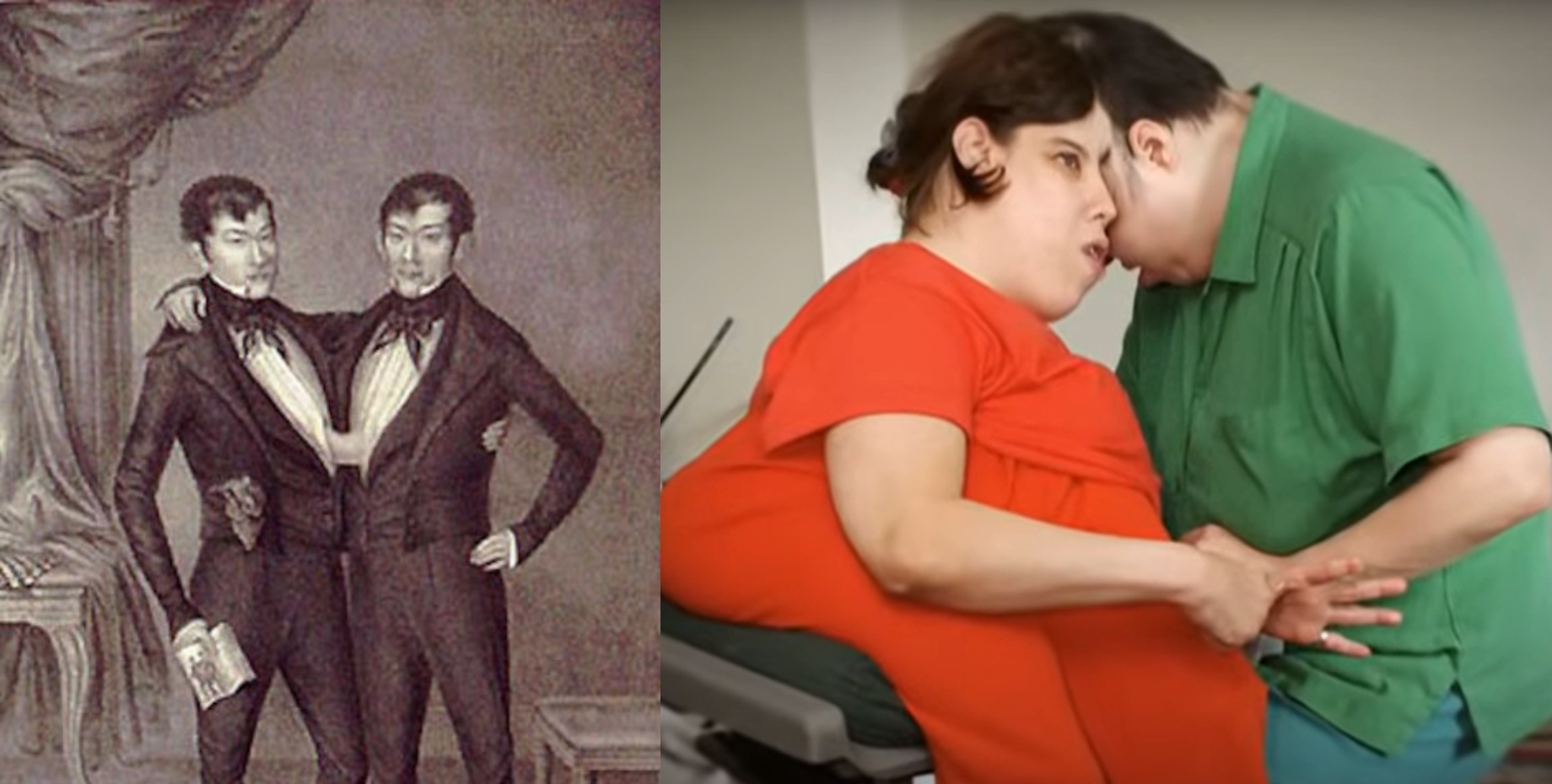 Рождаются примерно раз на 50-60 тысяч родов: известные истории сиамских близнецов (фото, видео)