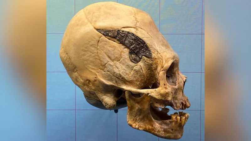 Археологи нашли следы самой первой операции в мире на черепе возрастом 2 тыс. лет (фото)