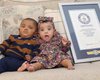 В Канаде родились необычные близнецы и сразу попали в Книгу рекордов Гиннеса