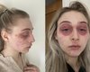 "Как жертва чумы": сильная аллергия на средство для ресниц изуродовала лицо девушки (фото)