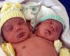В Бразилии родился ребенок с двумя головами