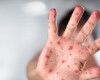 В Украине от кори умер 5-летний ребенок с противопоказаниями к вакцинации