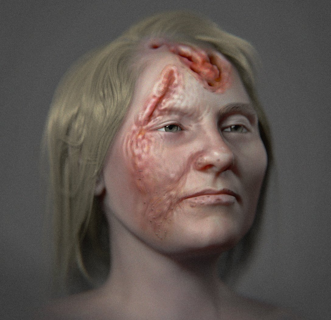 лицева реконструкция, жена със сифилис