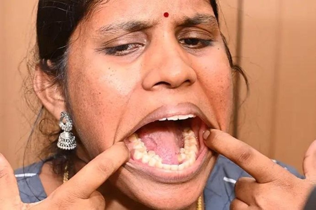 Жена с 36 зъба влезе в Книгата на рекордите на Гинес, зъболекарско досие, постижения