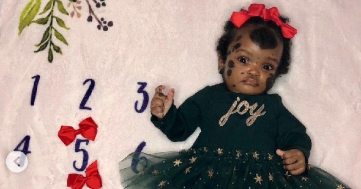 An unusual girl was born in the USA with spots all over her body (photo)