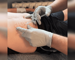 "Подарок от хирурга": врачи удаляют надпись "Слава России" с тела бойца после плена (фото)