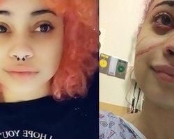 Кардашьян оплатит лечение девушке, изуродованной резиновой пулей во время протестов в США