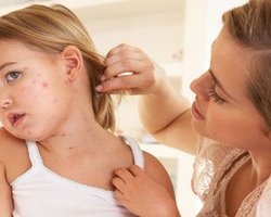 В Ивано-Франковской области из-за вспышки кори  закрыли две школы