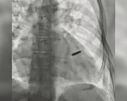 "Пощастило хлопцю": захисник "Азовсталі" провів три роки в полоні з кулею у серці (відео)