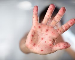 Количество заболевших корью в Киеве увеличилось до 74 человек