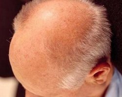 Раннее облысение у мужчин – признак рака простаты