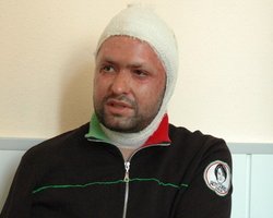 Облитому кислотой замгубернатору сделали пересадку кожи