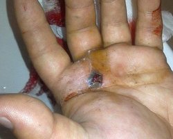 В ране мужчины в футболке Спасибо жителям Донбасса обнаружены остатки пороха, – Общее дело