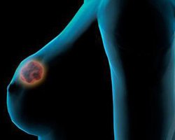 Ученые нашли отвечающие за рак груди гены