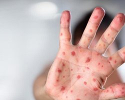 Корью в Украине за неделю заболели более 800 человек