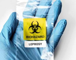 В країні ЄС вперше за 40 років виявлена проказа: небезпечну хворобу діагностували у масажисток
