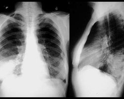 Украинцы умирают не от пневмонии, а от дистресс-синдрома, - черновицкие судмедэксперты