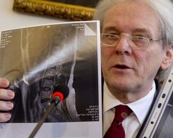 У Тимошенко хроническая грыжа межпозвоночного диска - немецкие врачи