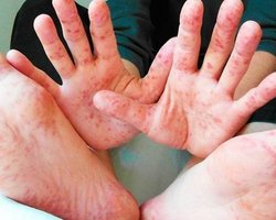 В Одесской области корью заболели 119 прихожан молитвенного дома