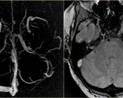 "Ризик тромбозу": Канада призупинила вакцинацію AstraZeneca для людей молодше 55 років