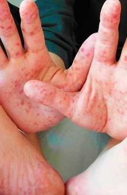 Необъявленная эпидемия. Сколько украинцев заболеют корью в 2019