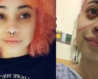 Кардашьян оплатит лечение девушке, изуродованной резиновой пулей во время протестов в США