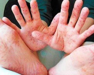 В январе корью заболели более 15 тысяч украинцев