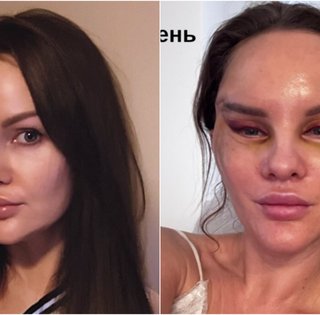 Росіянка образилась на земляків, які висміюють її невдалу пластичну операцію