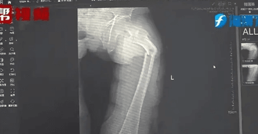 35-летний мужчина сломал самую крепкую кость в теле во время кашля: известна причина