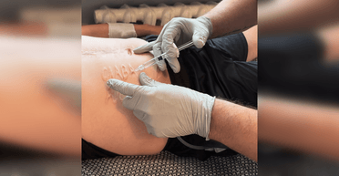 "Подарунок від хірурга": лікарі видаляють напис "Слава Росії" з тіла бійця після полону (фото)