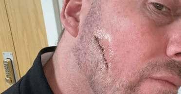 Мужчина отращивал бороду, чтобы прикрыть "пятно" на лице: это стоило ему здоровья