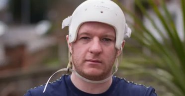 Отримав сильний удар: чоловікові відновили половину черепа із пластику (фото)