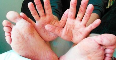 Необъявленная эпидемия. Сколько украинцев заболеют корью в 2019