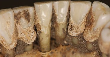 Зубной камень может раскрыть пристрастие древних людей к наркотикам