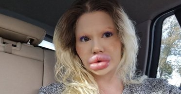 "Заважає працювати": жінці з "найбільшими губами" відмовили в лікуванні (фото)