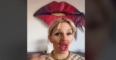 Мешают есть и занимают пол-лица: женщина уколола в губы рекордное количество филлеров (фото)