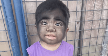 Мама звинувачує себе: через рідкісне захворювання дитина стала схожою на перевертня (фото)