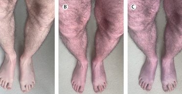 Рідкісне ускладнення після COVID-19: ноги чоловіка стали фіолетовими (фото)