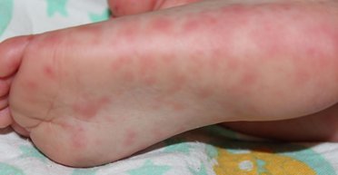 Не только в Киевской области: в Украине зафиксировали вспышку вируса Коксаки, как он проявляется (фото)