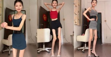 Люди хвилюються: неймовірно худа жінка з вагою 25 кг продовжує худнути (фото)