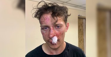 Экс-военного избили из-за прически в Киеве: нападавших отпустили, — соцсети (фото, видео)