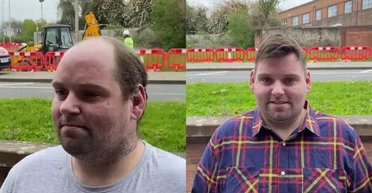 Історія "повернення волосся": лисий чоловік розридався через нову зачіску (відео)