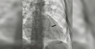 "Пощастило хлопцю": захисник "Азовсталі" провів три роки в полоні з кулею у серці (відео)