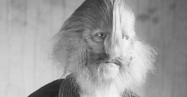 "Обличчя лева": чоловік із рідкісним захворюванням став світовою сенсацією (фото, відео)