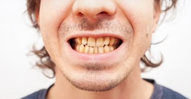 Сильно желтеют зубы: стоматологи указали на малоизвестную ошибку при чистке зубов