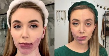 "Люди дивилися": жінка перенесла 20 операцій через родиму пляму на обличчі (фото)