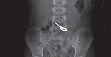 Шестилетний ребенок проглотил ключ и молчал: врачи 3 дня ждали, что произойдет