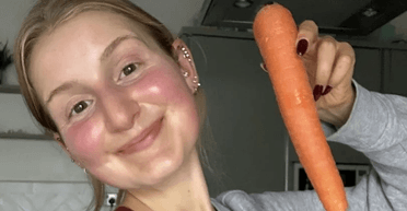 "Корисно для здоров'я": дівчина з'їла так багато моркви, що шкіра стала помаранчевою (фото)