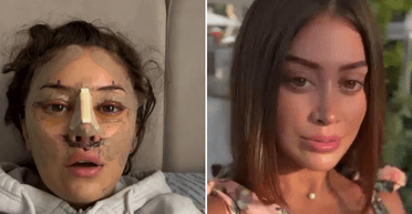 Женщина сделала подтяжку в Турции: люди говорят, что это "роковая ошибка" (фото)