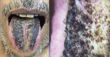 "Волосатый" язык. Дерматологи диагностировали у жителя США редкое заболевание (фото)